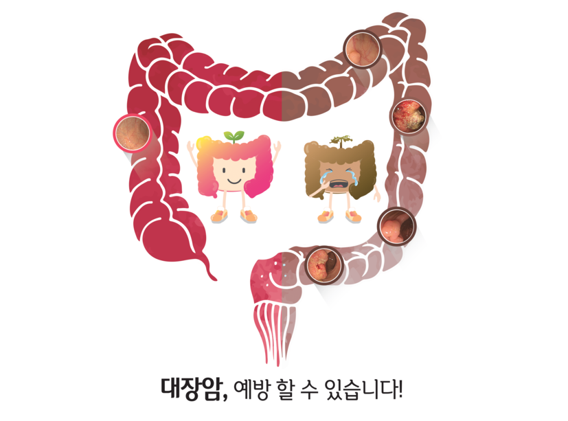 대장암 예방 홍보 포스터 사진