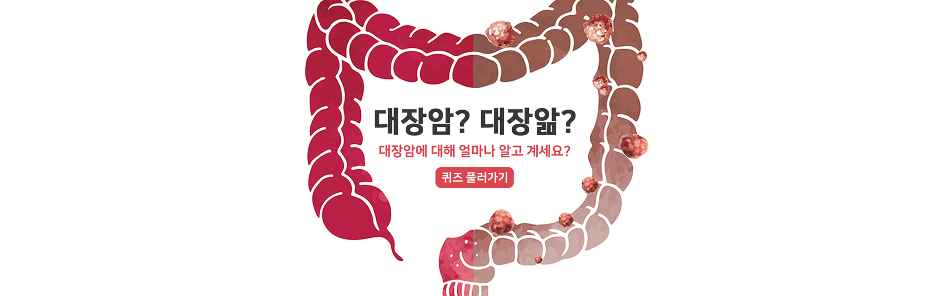 대장암 퀴즈 맞추러가기