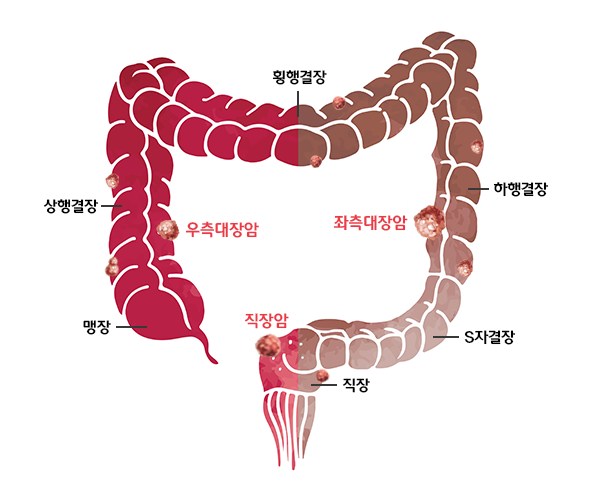 대장과 대장암의 위치 사진